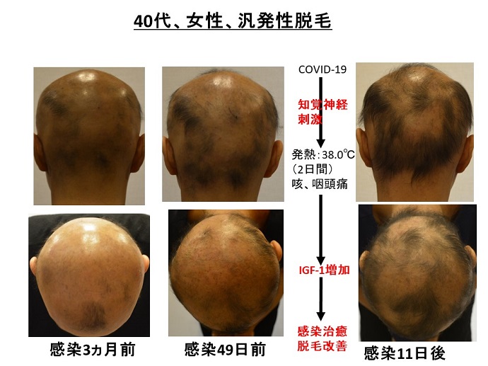 円形脱毛症　病院